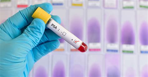 alcohol and psa test|How To Prepare For A PSA Blood Test & What To .